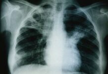 Intensification de la lutte contre la tuberculose en Haïti