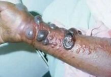 Haïti et la République Dominicaine veulent prévenir le virus de l’Ebola